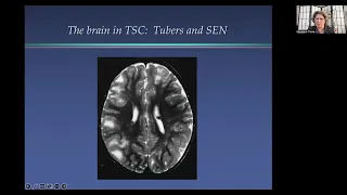 The Neurology of Tuberous Sclerosis Complex: Epilepsy, Cognition and Behavior