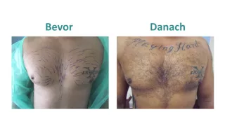 Haartransplantation im Brustbereich bei Männern mit der Methode der Advanced FUE