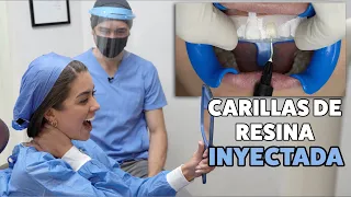 Carillas de Resina ¿Cómo es un Diseño de Sonrisa BIEN PLANEADO? ¡Caso Real, Paso a Paso!