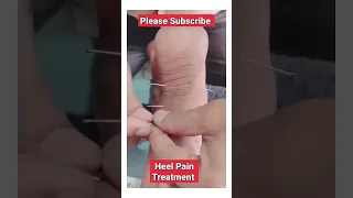 Treatment for heel pain #shorts #youtubeshorts #viral #heelpain #dryneedling #health #painrelief