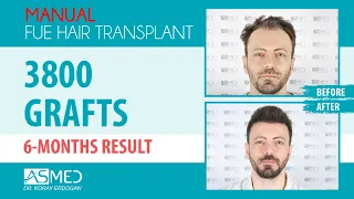 Manual FUE Hair Transplant 3800 Grafts 6 Months Result  @asmedhairtransplant ​