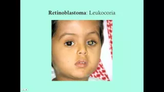 Retinoblastoma - CRASH! Medical Review Series