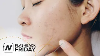 Flashback Friday: Saving Lives by Treating Acne with Diet