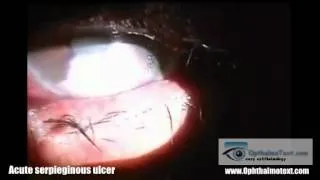 hypopyon corneal ulcer (Acute serpieginous ulcer)