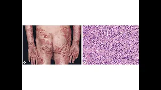 Cutaneous T cell lymphomas