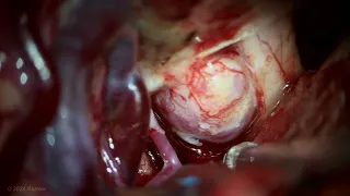 Clipping of an Ophthalmic Artery Aneurysm with Intradural Anterior Clinoidectomy