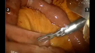 robotic gastric by pass tip & trick