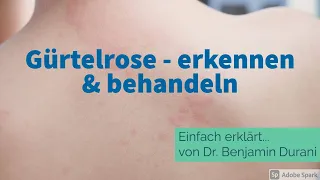 Gürtelrose - erkennen & behandeln - Einfach erklärt von Dr. Durani (Facharzt für Hautkrankheiten)