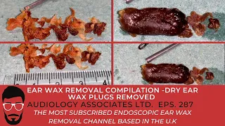 EAR WAX REMOVAL COMPILATION - LARGE WAX PLUGS REMOVED - EP 287