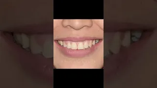 Profile improvement with braces