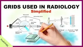 Grids Used in Radiology Simplified - Radiology