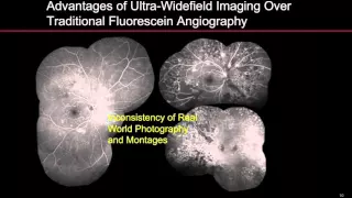 WEBINAR: Ultra-Widefield Fluorescein Angiography in the Management of Diabetic Retinopathy