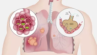 Lung Cancer | Pathophysiology and Nursing Interventions