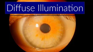 Diffuse Illumination - Slit Lamp Techniques