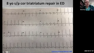 Mount Sinai Pediatric Cardiology EP Conference - 4.27.20 7 AM EST