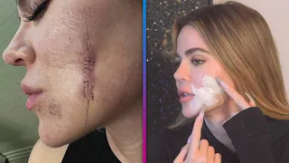 Khloé Kardashian Reveals Just How Scary Her Skin Cancer Situation Was