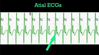 Atrial ECGs