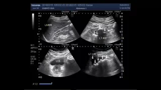 Ultrasound Video showing multiple ureteric stones with renal parenchymal disease.