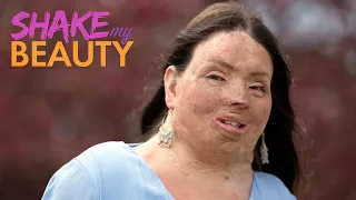 95% Of My Body Is Burnt | SHAKE MY BEAUTY