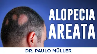 Alopecia Areata (Falhas no Cabelo) - Dr. Paulo Müller Dermatologista