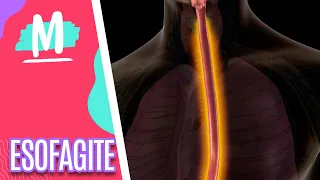Esclareça dúvidas sobre a esofagite - Mulheres (27/06/22)