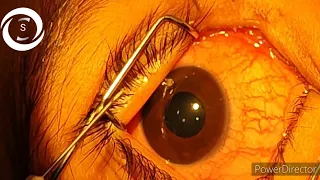 Corneal perforation post FB removal