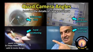 CataractCoach 1098: quad camera angles to learn cataract surgery