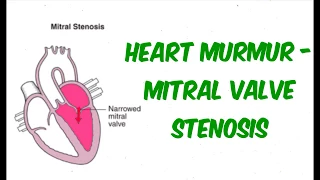 Mitral Valve Stenosis Explained Clearly - Pathophysiology, Symptoms, Treatment
