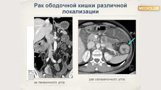 Роль КТ в стадіюванні раку ободової кишки