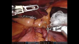 Robot assisted Biliopancreatic Diversion with Duodenal Switch- 5 STEPS