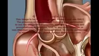 Aortic Dissection Rupture