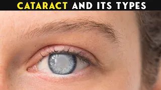 What Are Cataracts? | Cataract: Types, Causes and Risk Factors (Urdu/Hindi)