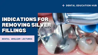 Indications for Removing Silver Fillings | Dental Amalgam Fillings