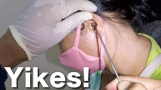 Massive Earwax Removed From Woman's Ear