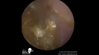 1,096   Complex Swollen & Infected Ear Wax Removal​ 022