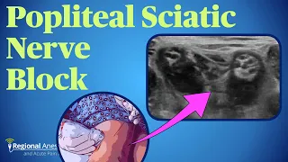 Popliteal Sciatic Nerve Block