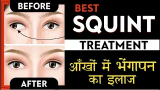 Best Squint treatment | Causes, Symptoms & Treatment of Squint - strabismus | भेंगापन का सरल इलाज |