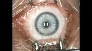 Лазерная коррекция зрения LASIK - ход операции