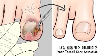 ASMR 시원함 주의! 리얼한 내성 발톱 케어 애니메이션 | Ingrown Toenail removal treatment animation