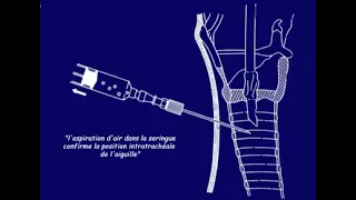 Trachéotomie percutanée sous endoscopie