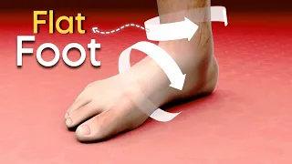Adult FlatFoot (3D Animation)Can Cure Without Surgery ?