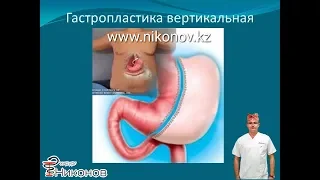 СЛИВ резекция желудка для похудения. Бариатрия в Алматы