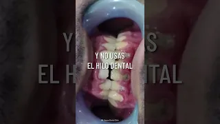 ¡Tenía gusanos en los dientes y no sabía! #shorts