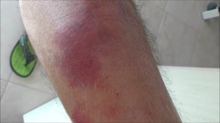 Cellulitis on a patient's shin before and 4 days after treatment