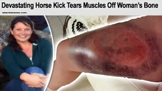 r/WellThatSucks | Horse Kicks Woman, Tearing Her Muscle From The Bone