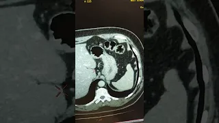 Gastro- intestinal stromal tumor (GIST). #mri #ct #abdomen #intestine #tumores #shorts