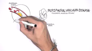 Cardiovascular Disease Overview