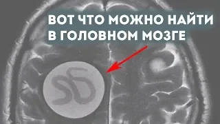 Вот что можно найти в головном мозге. Эхинококк. Удаление эхинококка