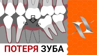 Что делать если удалили зуб? | Нужен ли имплантат?