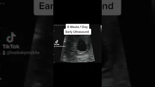 Heartbeat on Early Ultrasound at 6 Weeks 1 Day Pregnant